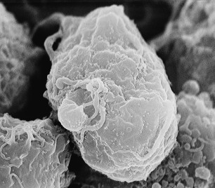 3. HIV, the cause of AIDS (Acquired Immunodeficiency Syndrome). Scanning electron micrograph of human immunodeficiency virus (HIV), grown in cultured lymphocytes. Virions are seen as small spheres on the surface of the cells. Photo Credit: C. Goldsmith, 1984, "Scanning electron micrograph of human immunodeficiency virus (HIV), grown in cultured lymphocytes", PHIL ID# 1843, Public Health Image Library (PHIL, http://phil.cdc.gov), Centers for Disease Control and Prevention (CDC, http://www.cdc.gov), United States Department of Health and Human Services (http://www.dhhs.gov), Government of the United States of America (USA).