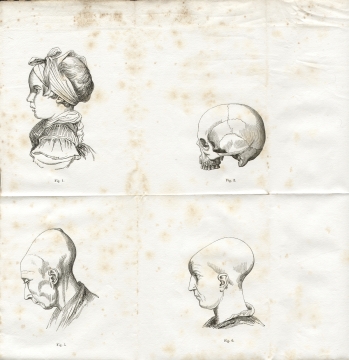 Fig. 1-2-5-6 - A. Foville : Dformation du crne... (1834)