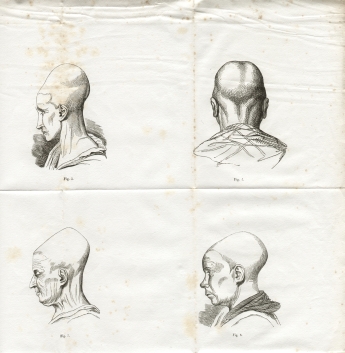 Fig. 3-4-7-8 - A. Foville : Dformation du crne... (1834)