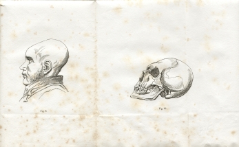 Fig. 9-10 - A. Foville : Dformation du crne... (1834)