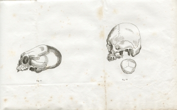 Fig. 11-12 - A. Foville : Dformation du crne... (1834)