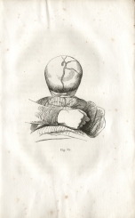 Fig. 13 - A. Foville : Dformation du crne... (1834)