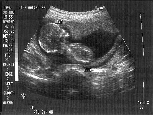 A Four-Month-Old Human Baby in Mother's the Womb, Second (2nd) Trimester, November 20, 1998. Photo Credit: CDC/Jim Gathany, 'Ultrasound image of fetus at four months.', PHIL ID# 1666, Public Health Image Library (PHIL, http://phil.cdc.gov), Centers for Disease Control and Prevention (CDC, http://www.cdc.gov), United States Department of Health and Human Services (http://www.dhhs.gov), Government of the United States of America (USA).